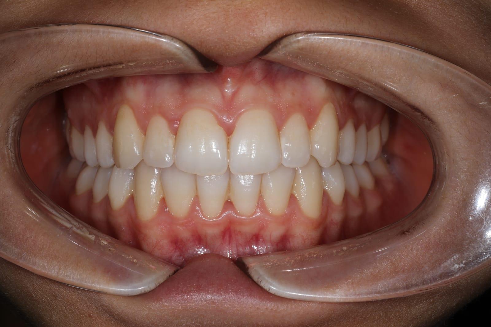 Risultato ortodontico dopo trattamento con allineatori