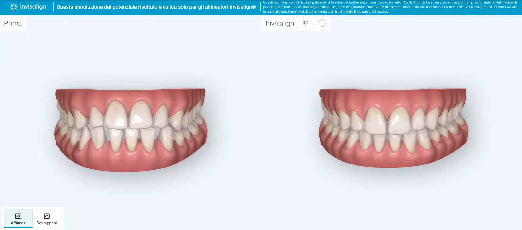 Simulazione digitale pre e post trattamento